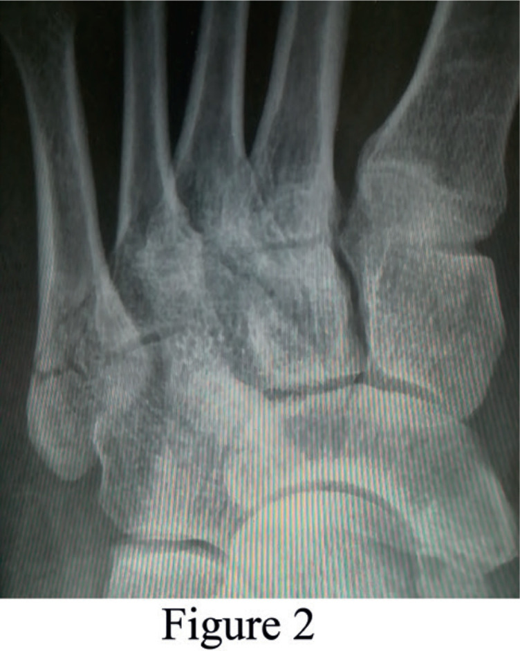 Early Active Rehabilitation Treatment for a Patient with a Stable Type of Fifth Metatarsal Base Fracture: a Case Report.