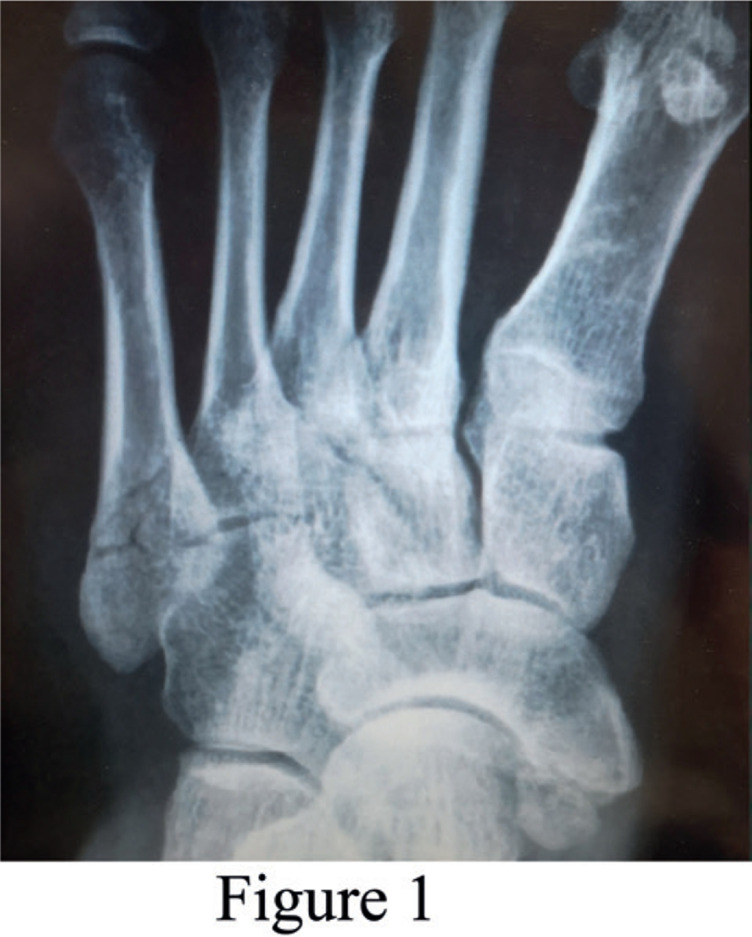 Early Active Rehabilitation Treatment for a Patient with a Stable Type of Fifth Metatarsal Base Fracture: a Case Report.