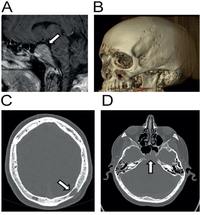 Pituitary metastasis: a clinical overview.