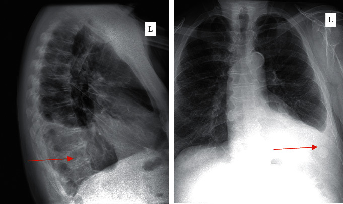 Hyper IgG4-Related Disease Presenting with Orbital Tumor and Immune Deficiency.