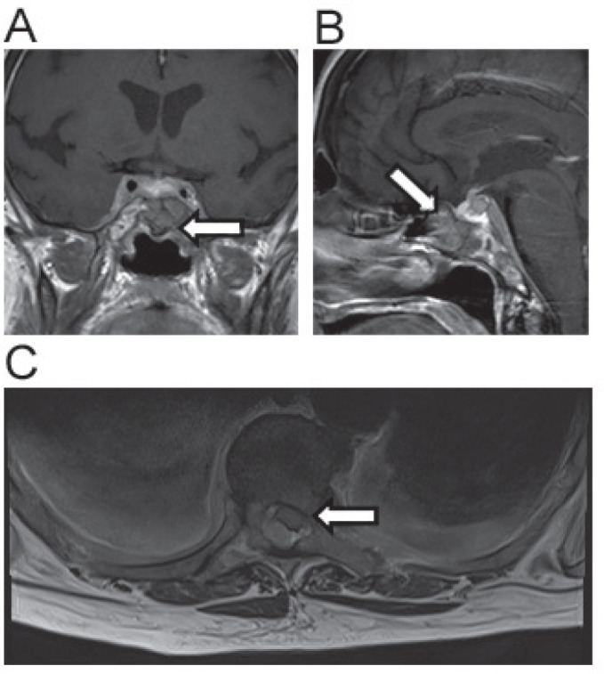 Pituitary metastasis: a clinical overview.