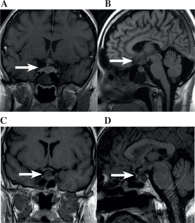 Pituitary metastasis: a clinical overview.