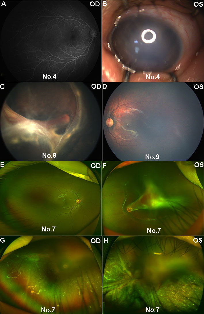 Identification of a novel mutation in <i>KIF11</i> with functional analysis in a cohort of 516 familial patients with exudative vitreoretinopathy.