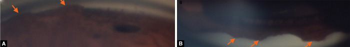 Iridocorneal Endothelial Syndrome with Coexisting Macular Edema and Neurosensory Detachment: An Unusual Case Report.