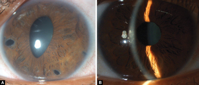 Iridocorneal Endothelial Syndrome with Coexisting Macular Edema and Neurosensory Detachment: An Unusual Case Report.