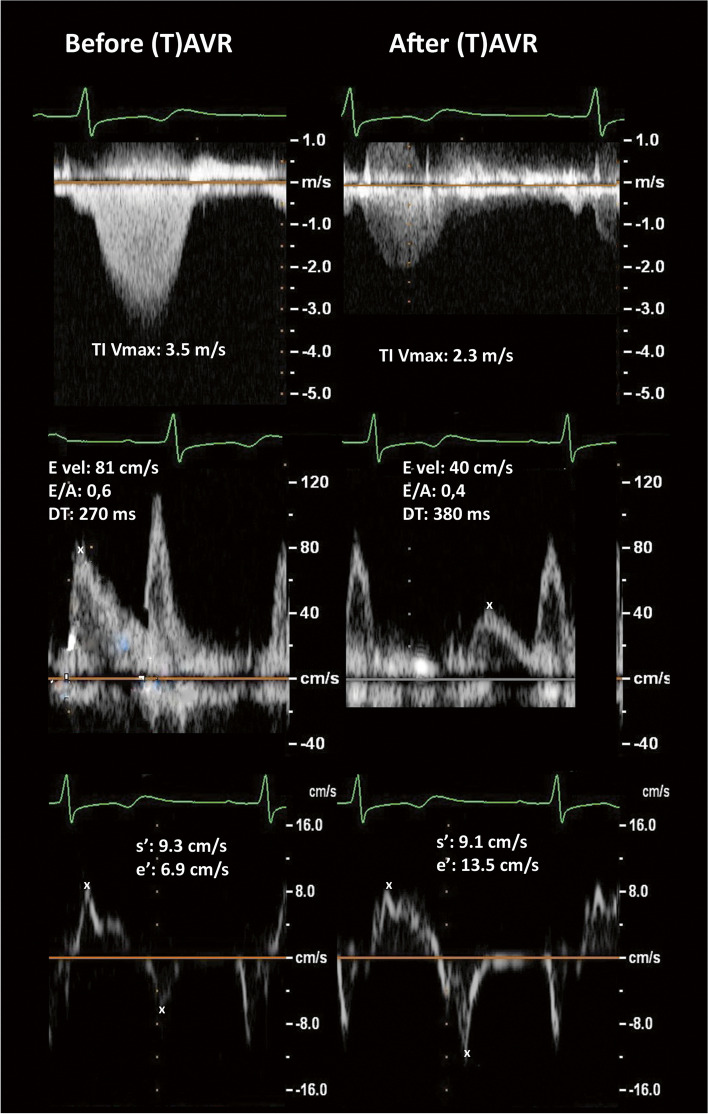 Echocardiographic assessment of diastolic dysfunction in elderly patients with severe aortic stenosis before and after aortic valve replacement.