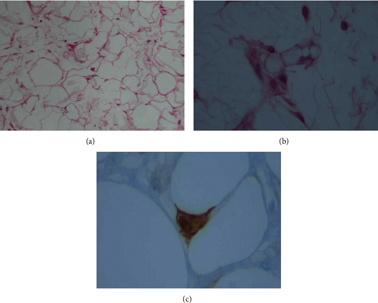 Gastrointestinal Stromal Tumor (GIST) and Synchronous Intra-Abdominal Liposarcoma: A Report of Two Rare Cases and Literature Review.