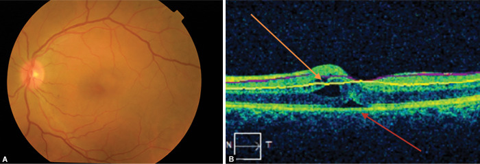 Iridocorneal Endothelial Syndrome with Coexisting Macular Edema and Neurosensory Detachment: An Unusual Case Report.