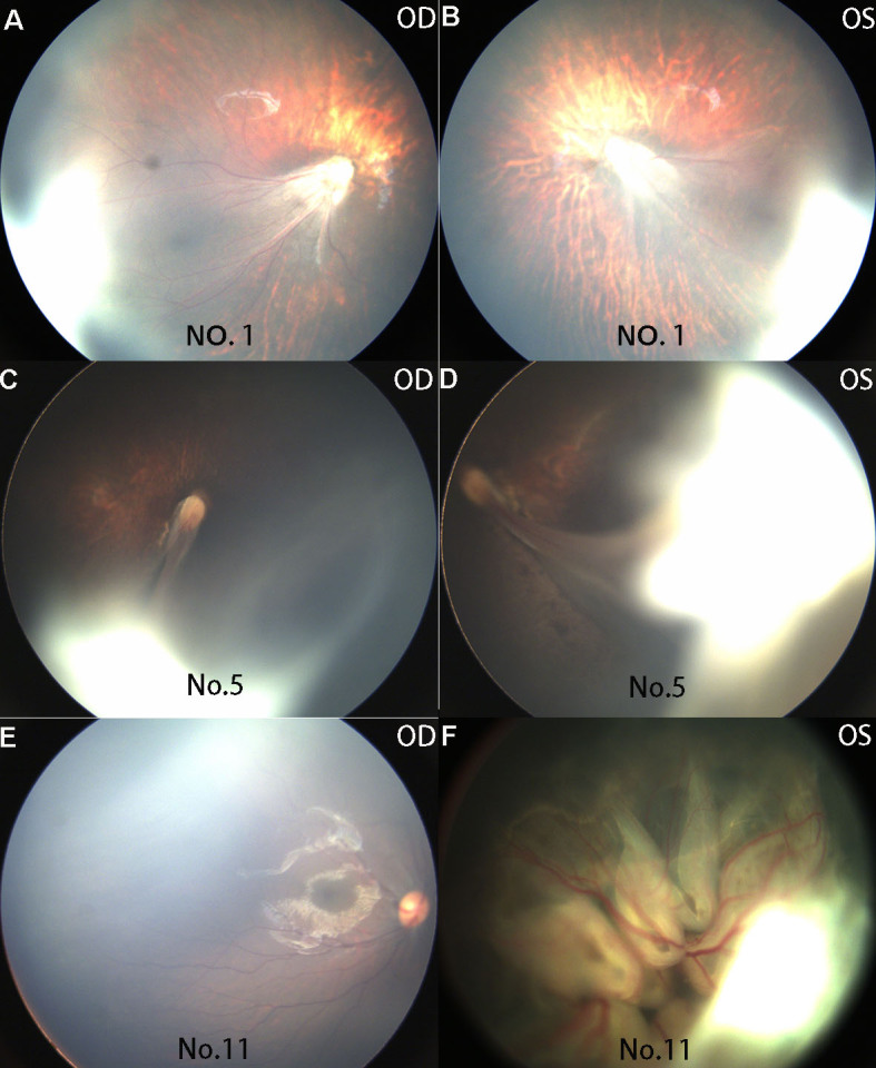 Identification of a novel mutation in <i>KIF11</i> with functional analysis in a cohort of 516 familial patients with exudative vitreoretinopathy.