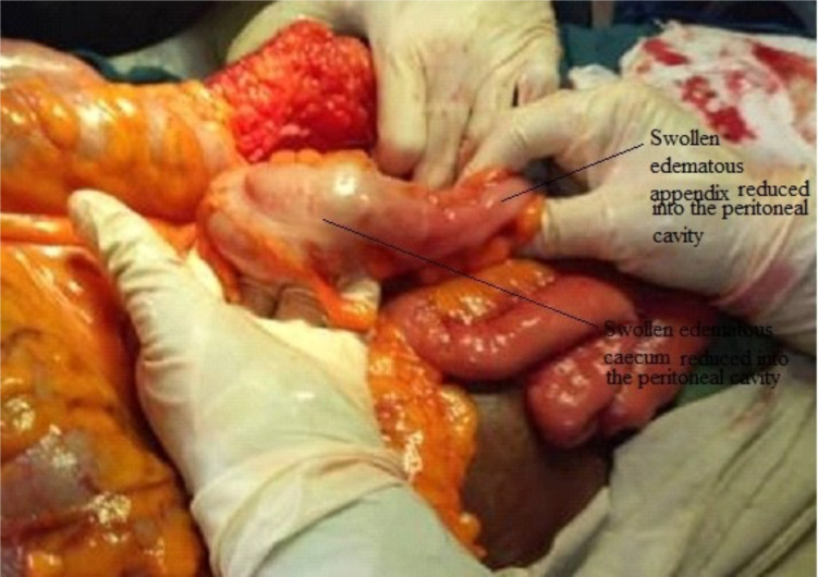 Obstructed right Duari hernia.