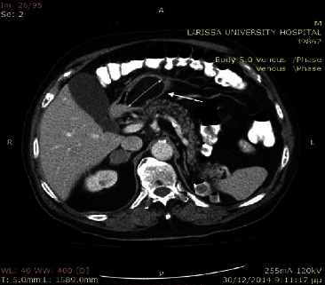 Gastrointestinal Stromal Tumor (GIST) and Synchronous Intra-Abdominal Liposarcoma: A Report of Two Rare Cases and Literature Review.