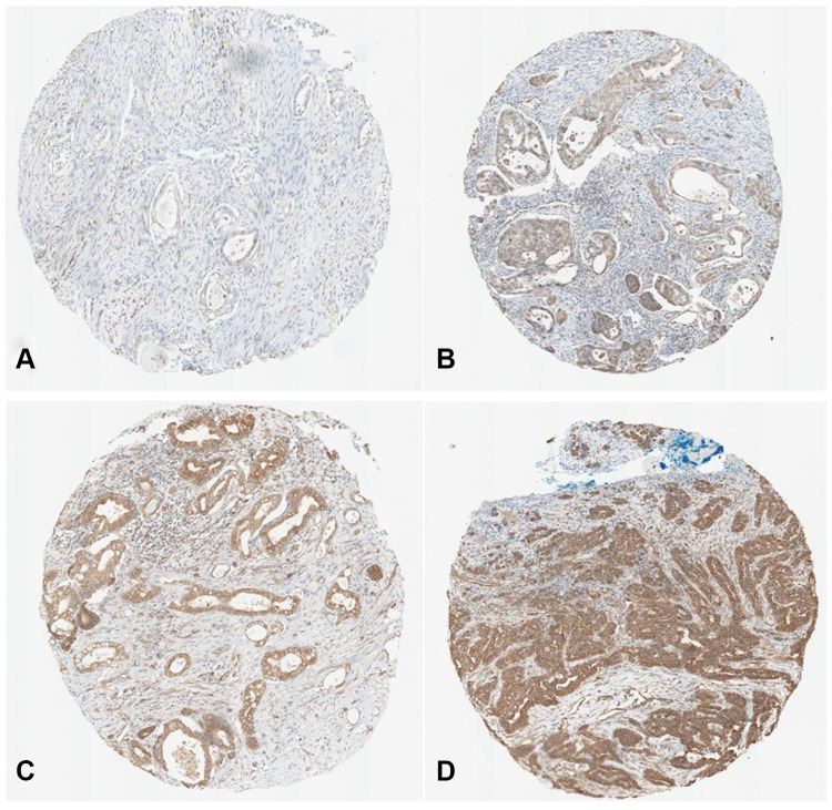 Phosphomannose Isomerase High Expression Associated with Better Prognosis in Pancreatic Ductal Adenocarcinoma.