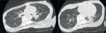 Diagnosis and treatment of pneumonia, a common cause of respiratory failure in patients with neuromuscular disorders.