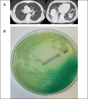 Diagnosis and treatment of pneumonia, a common cause of respiratory failure in patients with neuromuscular disorders.