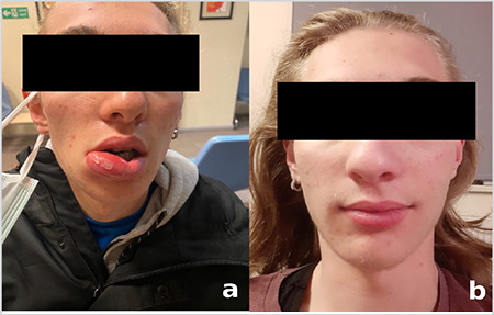 Immunocompetent Young Patient Presenting with Unilateral Lip Abscess Due to Peeling Exfoliated Lip Skin.