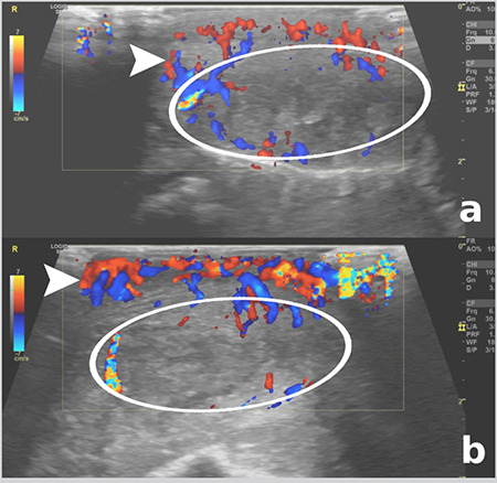 Immunocompetent Young Patient Presenting with Unilateral Lip Abscess Due to Peeling Exfoliated Lip Skin.