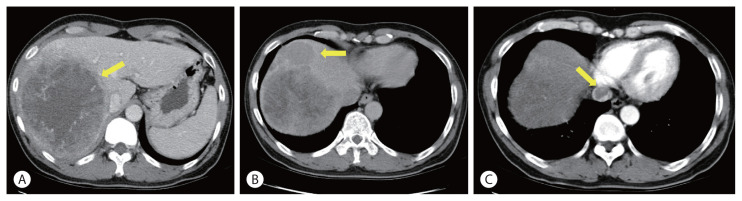 Curative liver transplantation after lung resection for advanced hepatocellular carcinoma with lung metastasis and inferior vena cava tumor thrombosis: a case report.