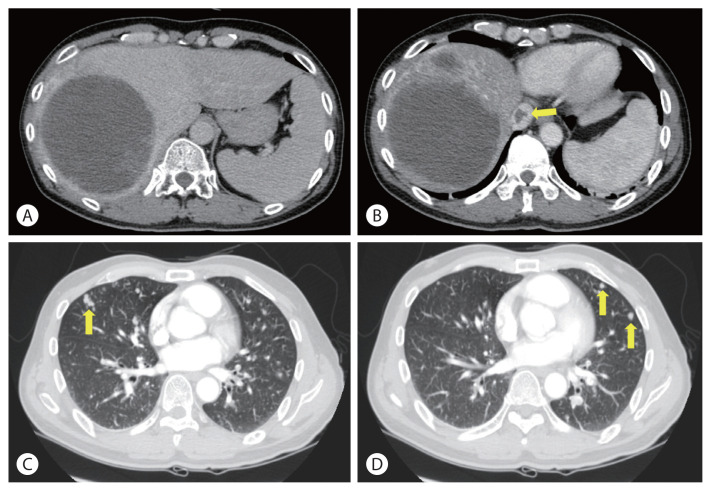 Curative liver transplantation after lung resection for advanced hepatocellular carcinoma with lung metastasis and inferior vena cava tumor thrombosis: a case report.