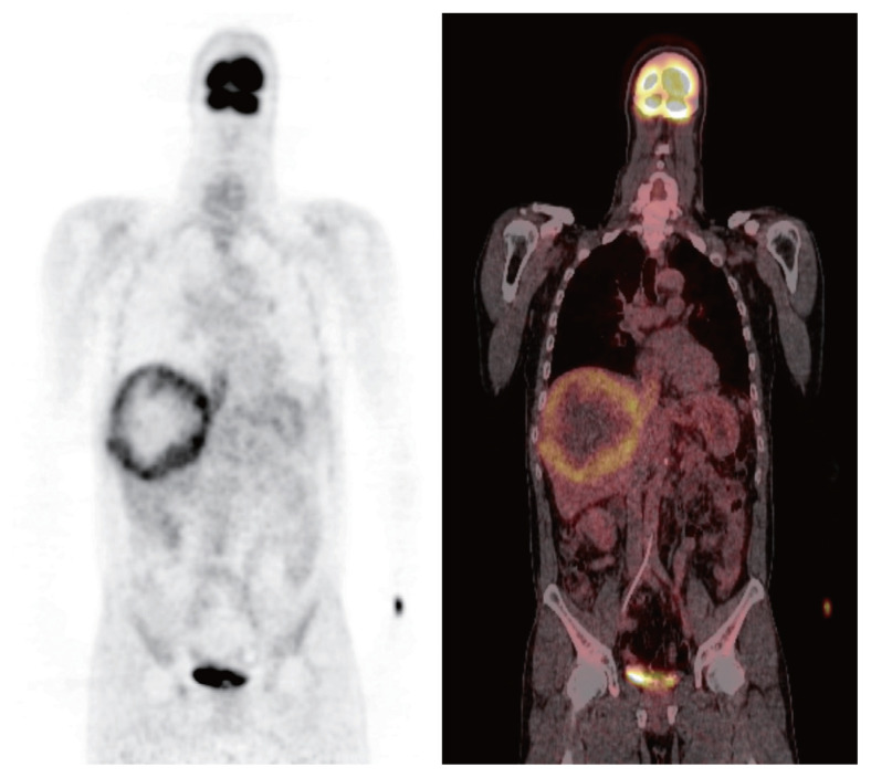 Curative liver transplantation after lung resection for advanced hepatocellular carcinoma with lung metastasis and inferior vena cava tumor thrombosis: a case report.