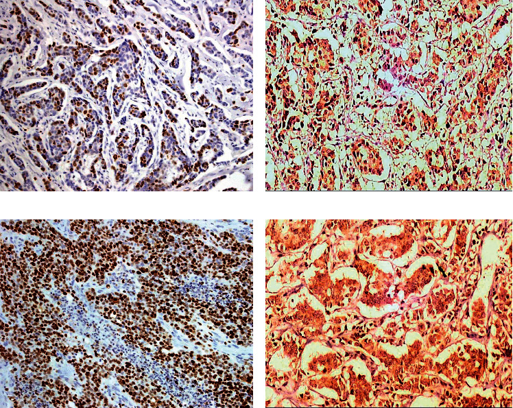 The Utility of SOX2 and AGR2 Biomarkers as Early Predictors of Tamoxifen Resistance in ER-Positive Breast Cancer Patients.