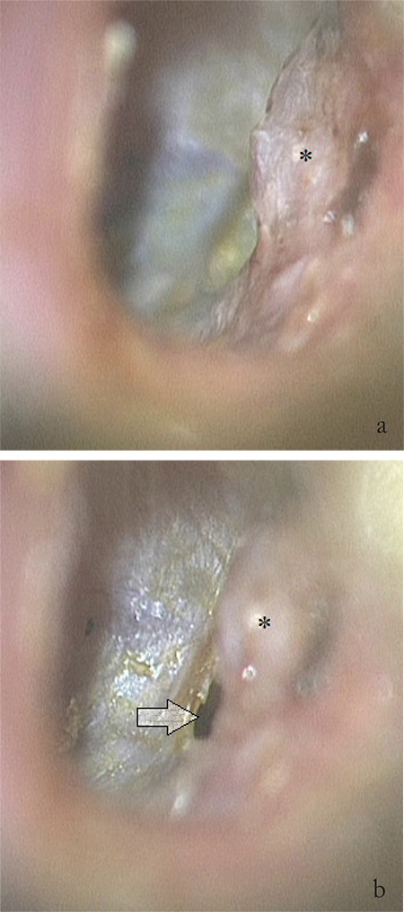 An Incidental Chorda Tympani Schwannoma Identified During Middle Ear Surgery.