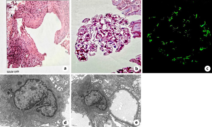 An Overlooked Link between IgA Nephropathy and Lithium Toxicity: A Case Report.