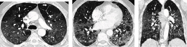 Human Ace D/I Polymorphism Could Affect the Clinicobiological Course of COVID-19.