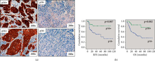 Prognostic Significance of a Scoring System Combining p16, Smoking, and Drinking Status in a Series of 131 Patients with Oropharyngeal Cancers.