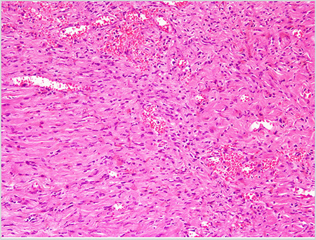 An Incidental Chorda Tympani Schwannoma Identified During Middle Ear Surgery.