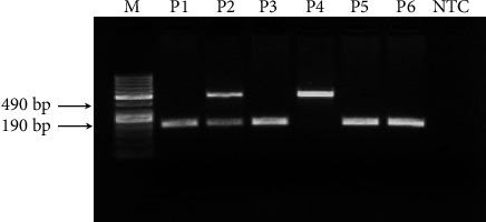 Human Ace D/I Polymorphism Could Affect the Clinicobiological Course of COVID-19.