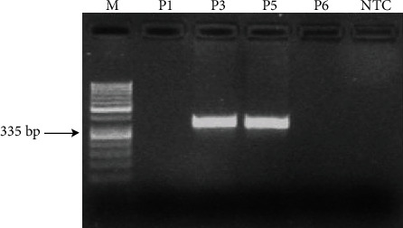 Human Ace D/I Polymorphism Could Affect the Clinicobiological Course of COVID-19.