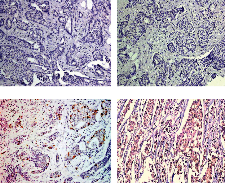 The Utility of SOX2 and AGR2 Biomarkers as Early Predictors of Tamoxifen Resistance in ER-Positive Breast Cancer Patients.