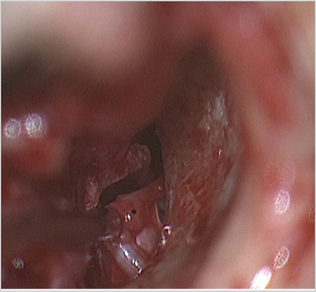 An Incidental Chorda Tympani Schwannoma Identified During Middle Ear Surgery.