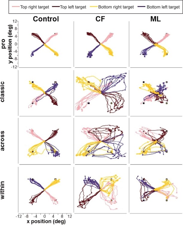 Impaired Spatial Inhibition Processes for Interhemispheric Anti-saccades following Dorsal Posterior Parietal Lesions.