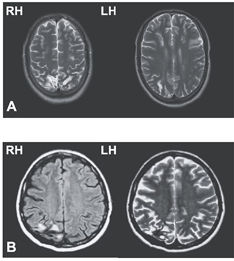 Impaired Spatial Inhibition Processes for Interhemispheric Anti-saccades following Dorsal Posterior Parietal Lesions.