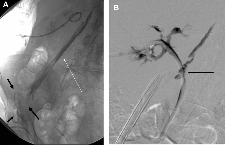 Xanthogranulomatous Pyelonephritis: A Narrative Review with Current Perspectives on Diagnostic Imaging and Management, Including Interventional Radiology Techniques.