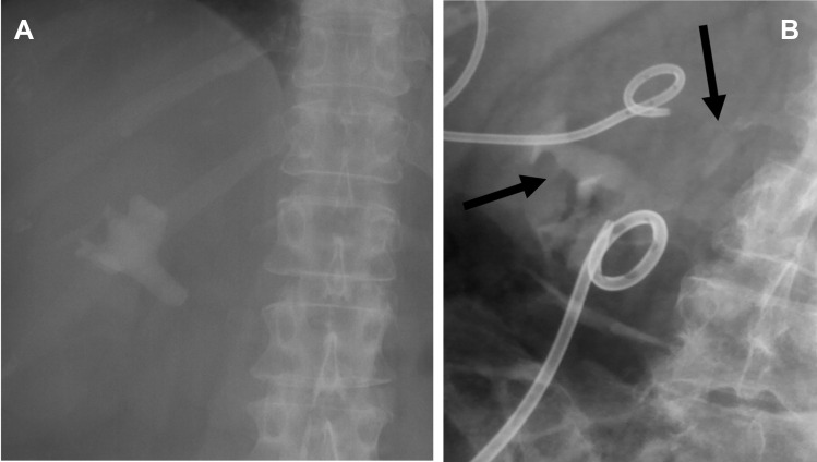 Xanthogranulomatous Pyelonephritis: A Narrative Review with Current Perspectives on Diagnostic Imaging and Management, Including Interventional Radiology Techniques.