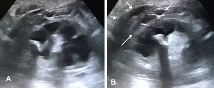 Xanthogranulomatous Pyelonephritis: A Narrative Review with Current Perspectives on Diagnostic Imaging and Management, Including Interventional Radiology Techniques.