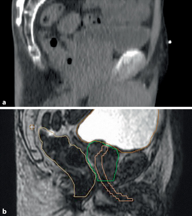 [Primary treatment of prostate cancer using 1.5 T MR-linear accelerator].