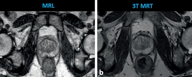 [Primary treatment of prostate cancer using 1.5 T MR-linear accelerator].