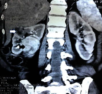 Concurrent Angiomyolipoma and Clear Cell Renal Cell Carcinoma in the Same Kidney: A Rare Finding in a Patient without Tuberous Sclerosis.