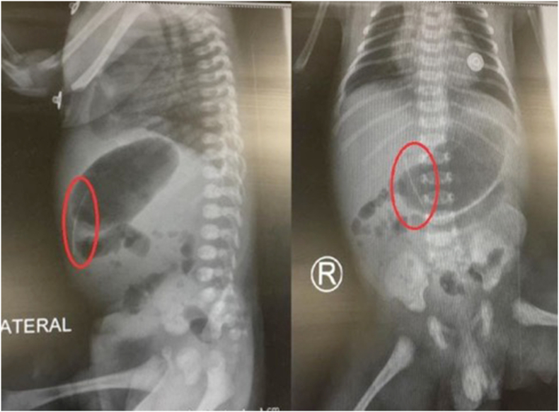 Umbilical catheter rupture: A serious complication in neonatal intensive care units