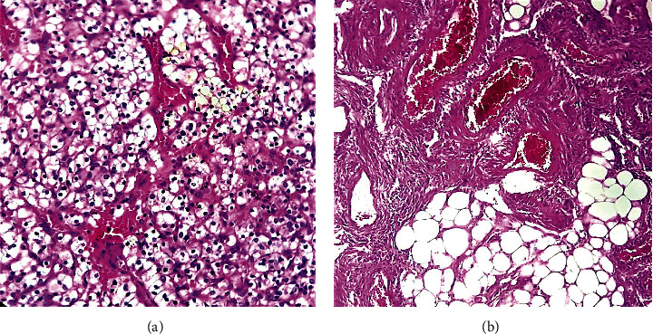 Concurrent Angiomyolipoma and Clear Cell Renal Cell Carcinoma in the Same Kidney: A Rare Finding in a Patient without Tuberous Sclerosis.