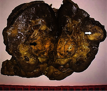 Concurrent Angiomyolipoma and Clear Cell Renal Cell Carcinoma in the Same Kidney: A Rare Finding in a Patient without Tuberous Sclerosis.