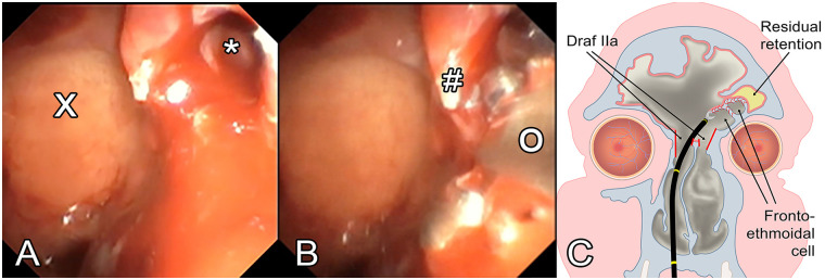 Minimally Invasive Endoscopic Sinus Surgery for Frontal Sinus Pathologies Using Interventional Flexible Bronchoscopy: Case Reports.