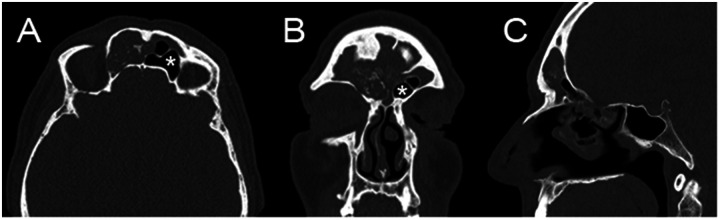 Minimally Invasive Endoscopic Sinus Surgery for Frontal Sinus Pathologies Using Interventional Flexible Bronchoscopy: Case Reports.