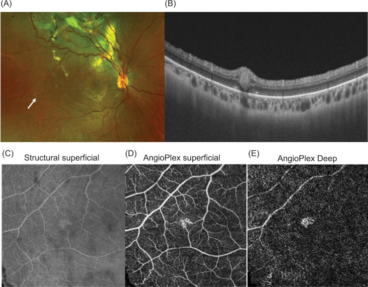 Optical Coherence Tomography Angiography of Early Stage 1a Retinal Hemangioblastoma in Von-Hippel-Lindau.