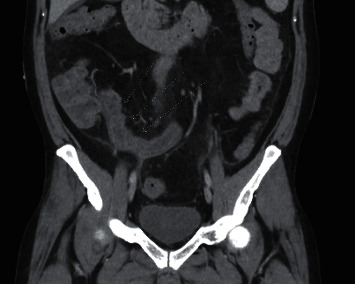 Novel Presentation of Terminal Ileitis Associated with Secukinumab Therapy.