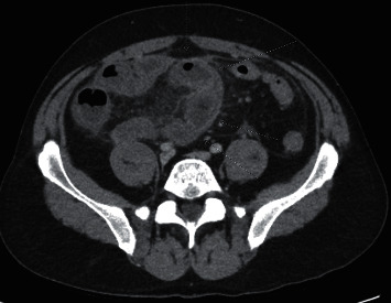 Novel Presentation of Terminal Ileitis Associated with Secukinumab Therapy.