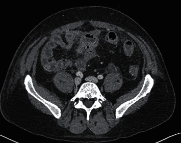 Novel Presentation of Terminal Ileitis Associated with Secukinumab Therapy.